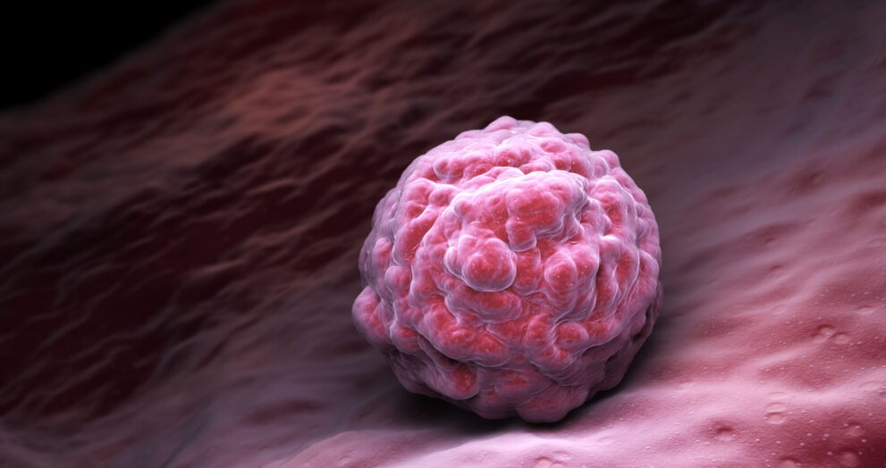 Fledgling AI trial spots breast cancer