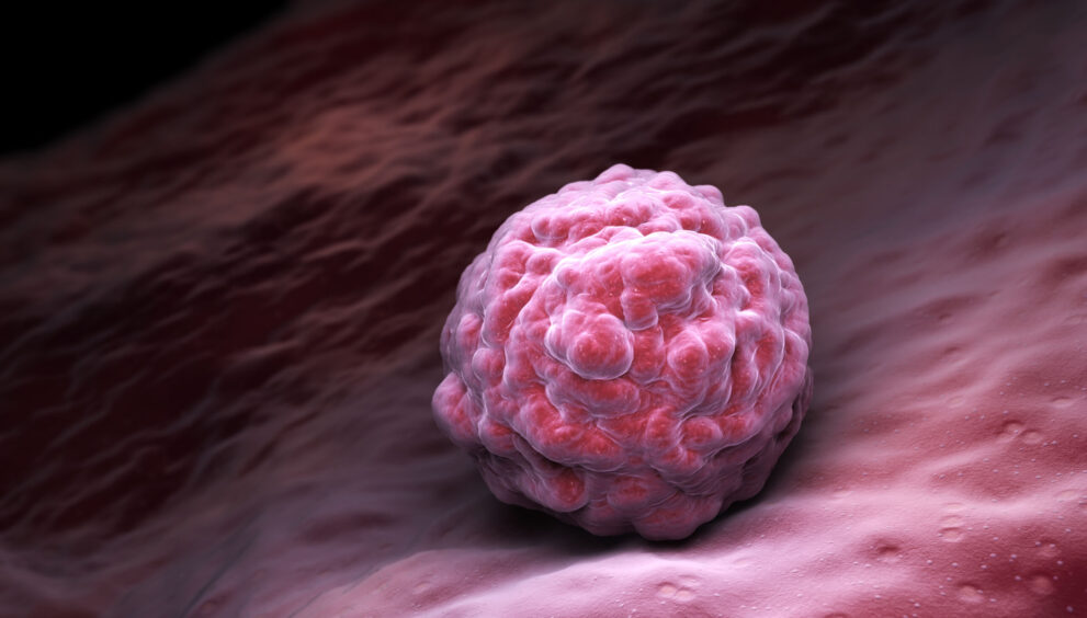Fledgling AI trial spots breast cancer