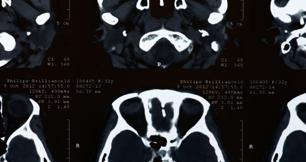 Cerebral palsy claims