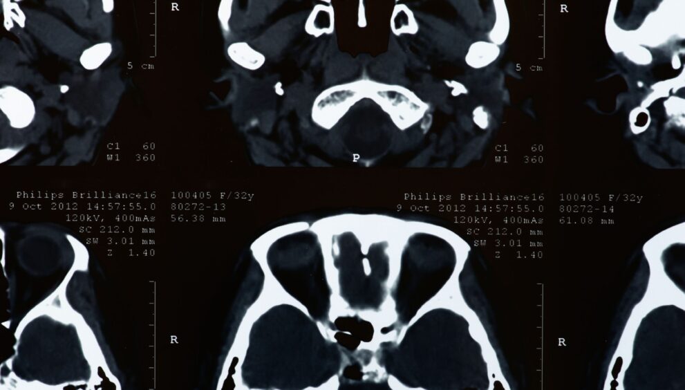 Cerebral palsy claims