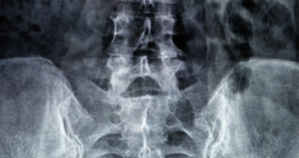 Cauda Equina Syndrome Claims