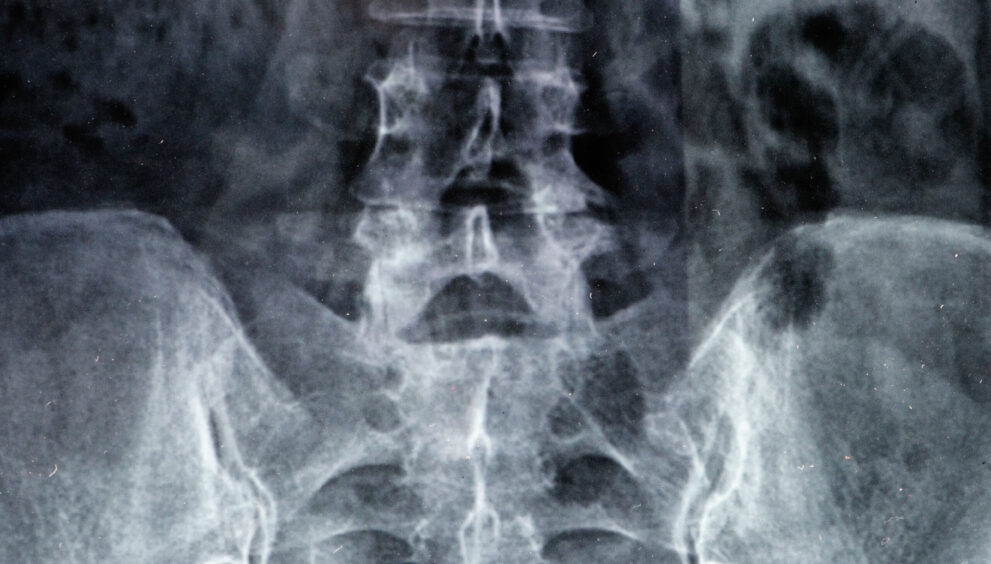 Cauda Equina Syndrome Claims